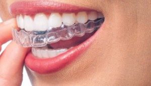 invisalign u ortodoncia invisible Dentistas en Madrid - Dental Denche