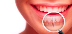implantes dentales en madrid Dental Denche